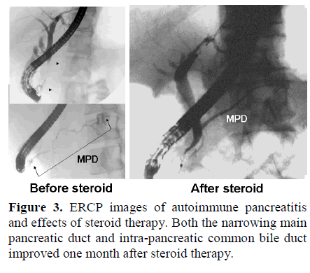 pancreas-ercp-images-autoimmune-pancreatitis