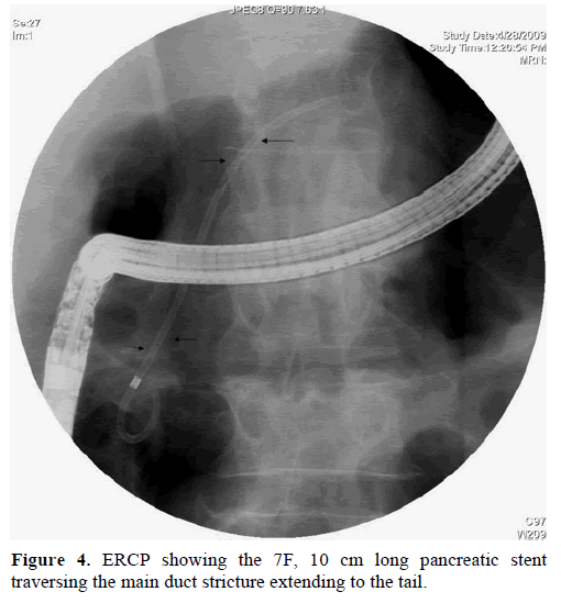 pancreas-ercp-long-pancreatic-stent