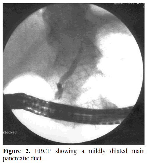 pancreas-ercp-mildly-pancreatic-duct