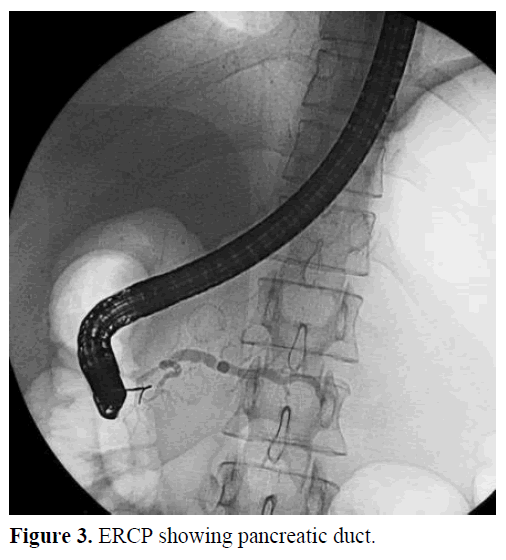 pancreas-ercp-pancreatic-duct