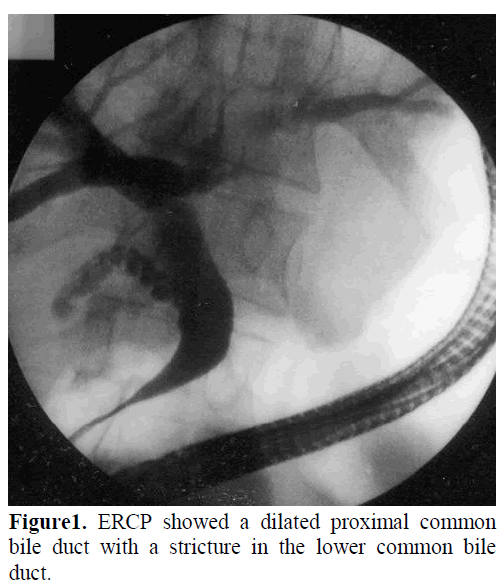 pancreas-ercp-proximal-bile-duct