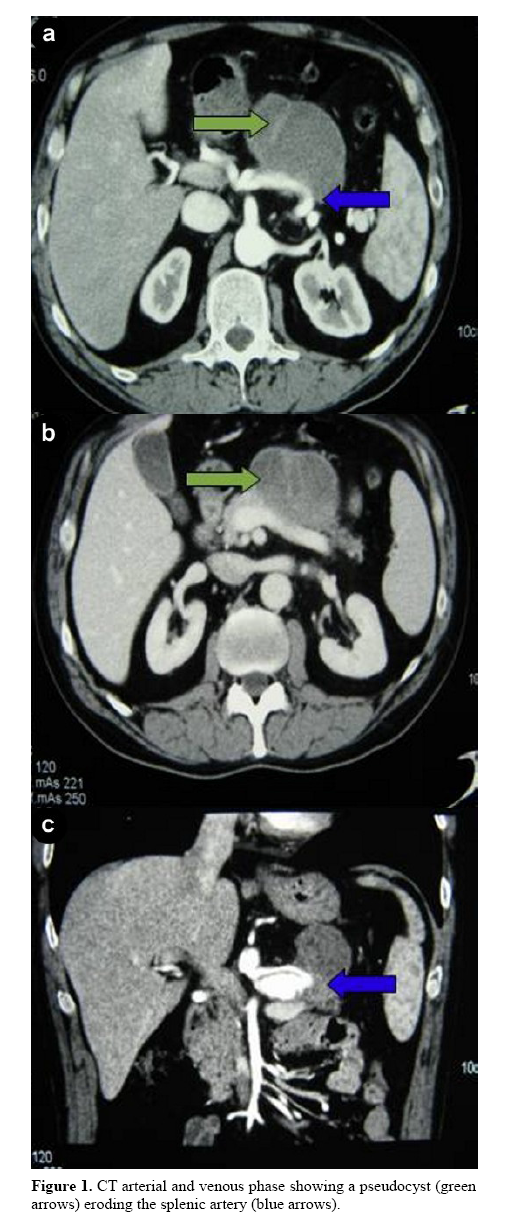 pancreas-eroding-splenic-artery