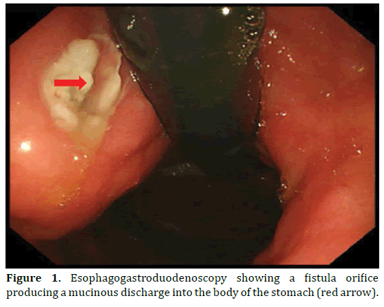pancreas-esophagogastroduodenoscopy