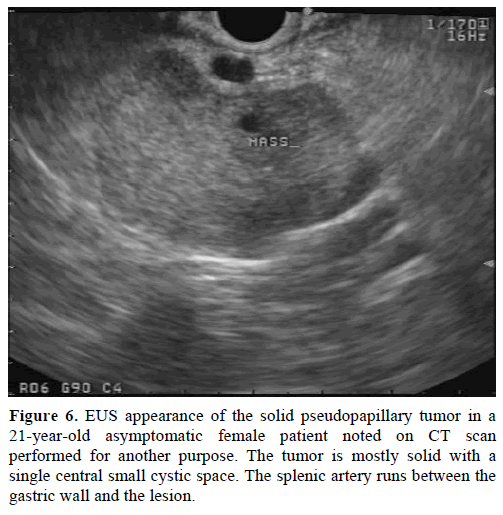 pancreas-eus-appearance-pseudopapillary