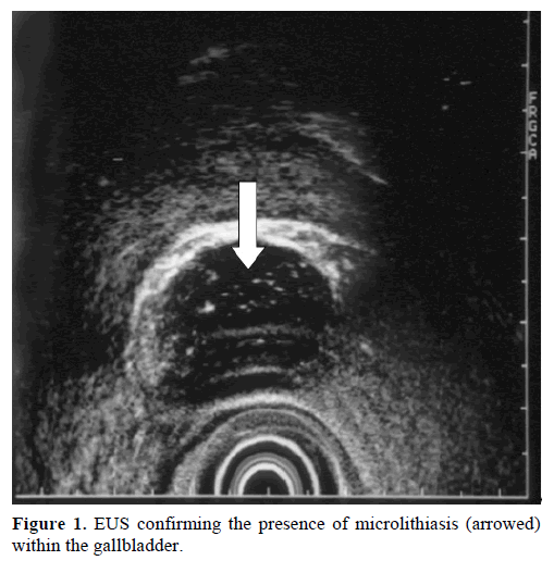 pancreas-eus-confirming-presence