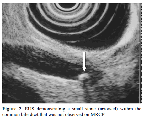 pancreas-eus-demonstrating-stone