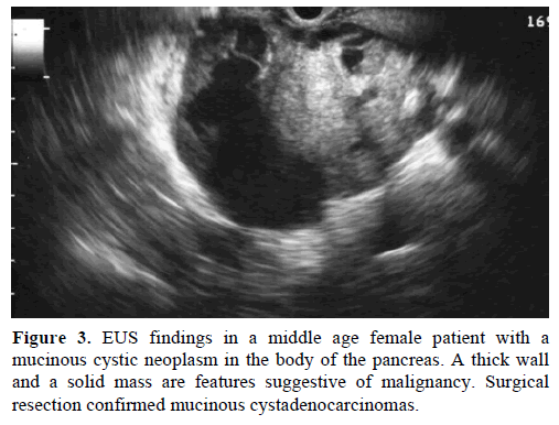 pancreas-eus-findings-middle-age