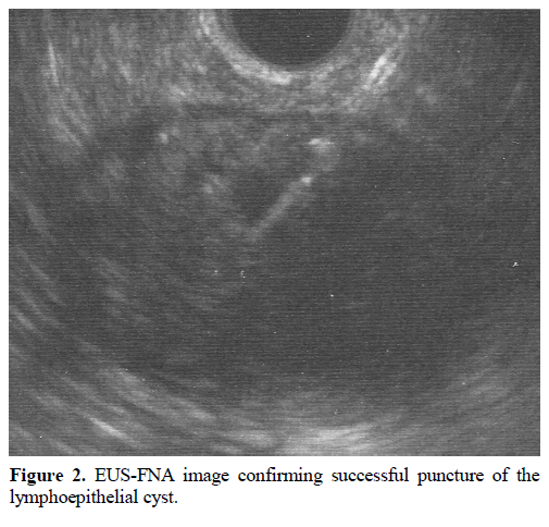 pancreas-eus-fna-image-lymphoepithelial