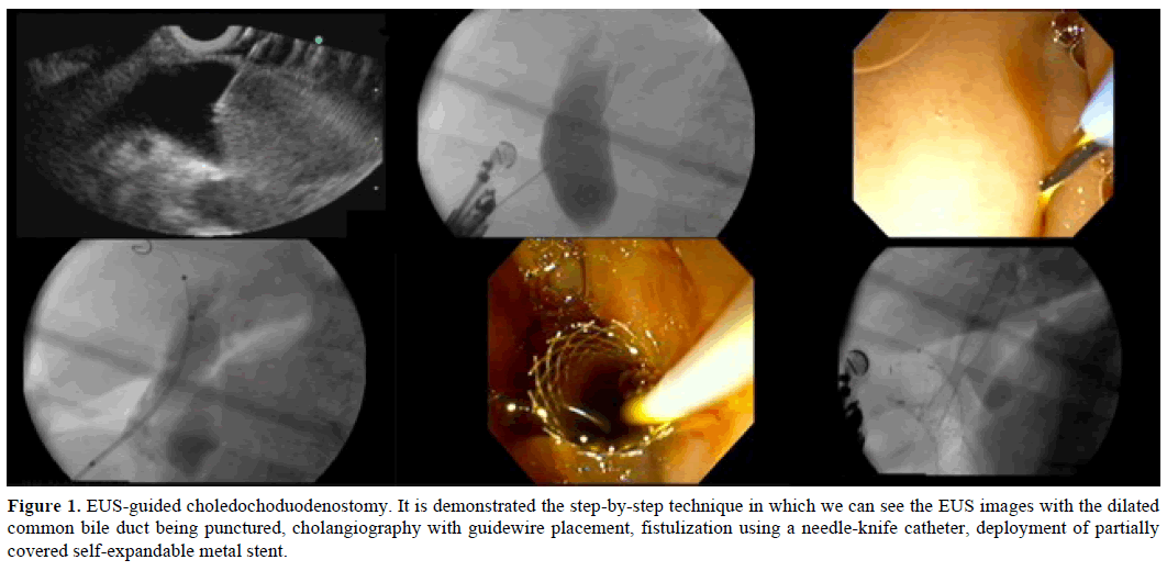 pancreas-eus-guided-choledochoduodenostomy