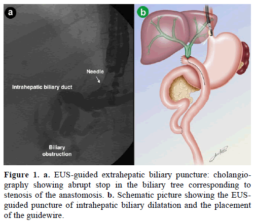 pancreas-eus-guided-extrahepatic-biliary