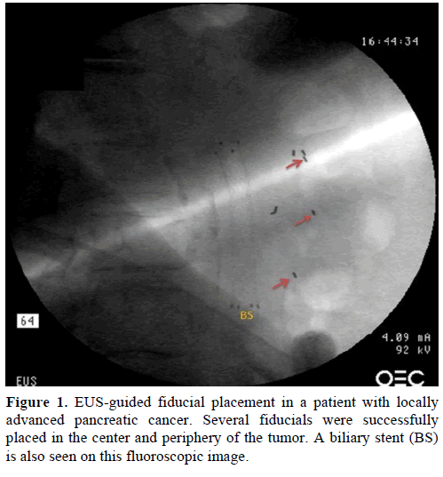 pancreas-eus-guided-fiducial-placement