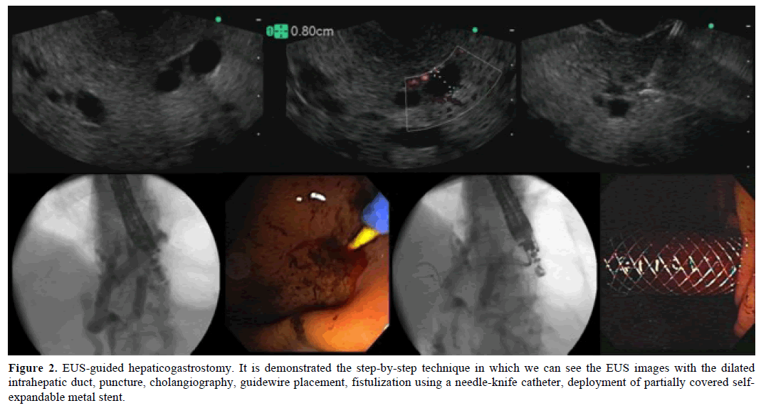 pancreas-eus-guided-hepaticogastrostomy