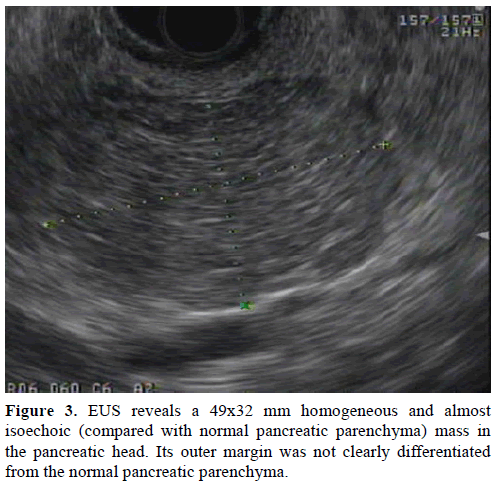 pancreas-eus-homogeneous-isoechoic