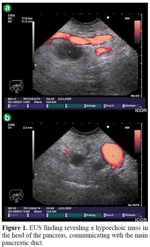 pancreas-eus-hypoechoic-mass-pancreas