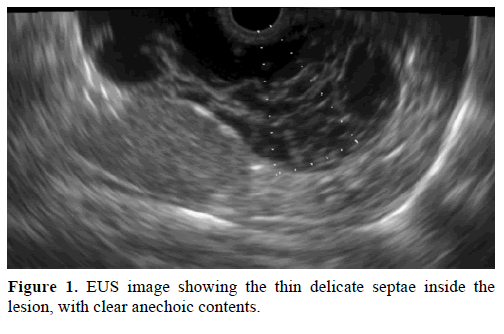 pancreas-eus-image-delicate-anechoic