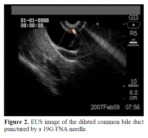 pancreas-eus-image-dilated-bile-duct