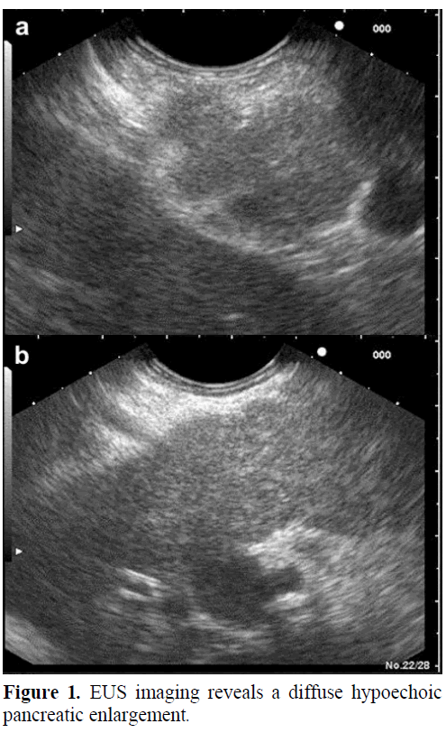 pancreas-eus-imaging-reveals-diffuse