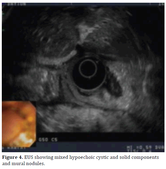 pancreas-eus-mixed-hypoechoic-cystic