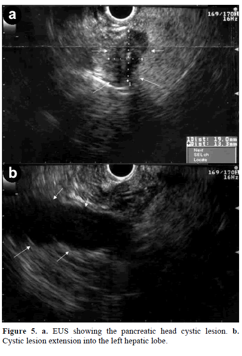 pancreas-eus-pancreatic-head-cystic