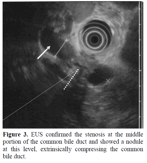 pancreas-eus-stenosis-common-bile-duct