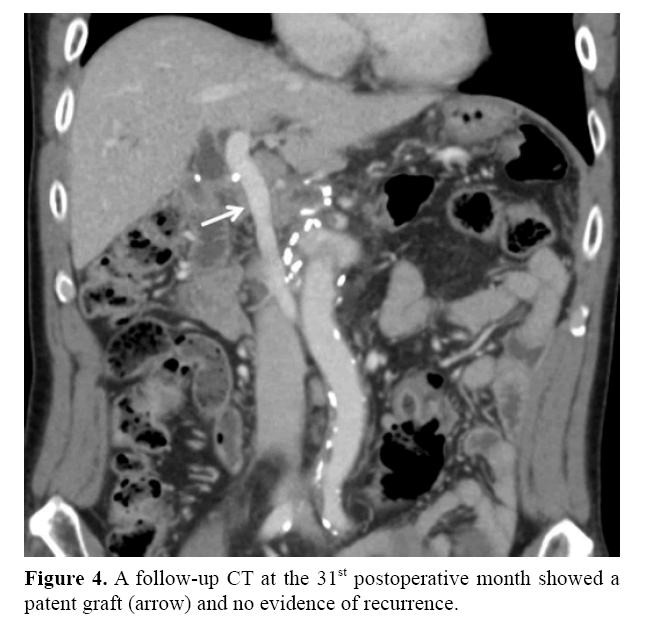 pancreas-evidence-recurrence