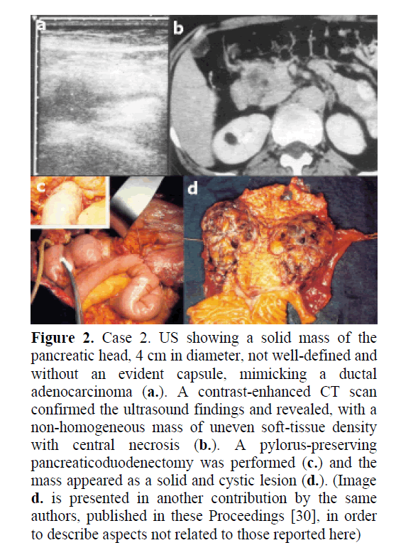 pancreas-evident-capsule-mimicking