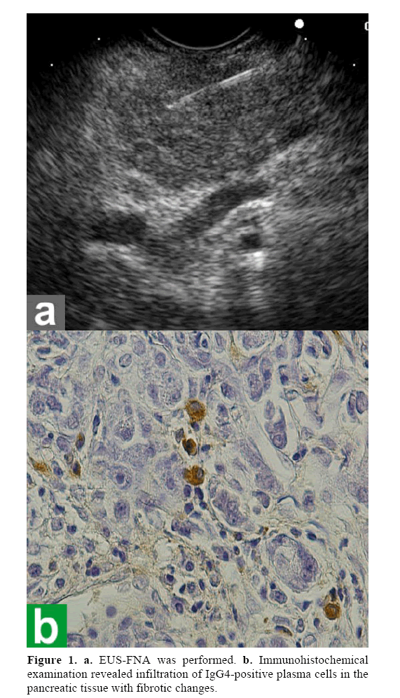 pancreas-examination-revealed-infiltration