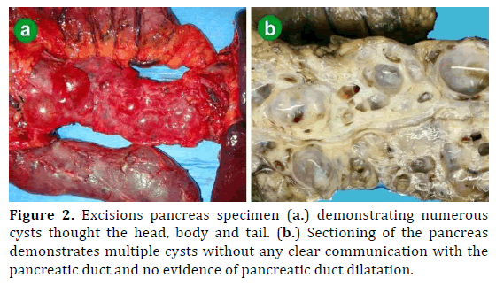 pancreas-excisions-pancreas-specimen