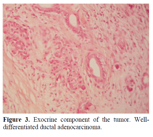 pancreas-exocrine-component-tumor
