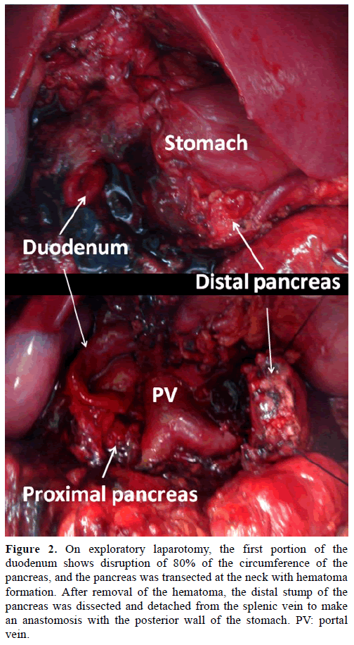 pancreas-exploratory-laparotomy-portion
