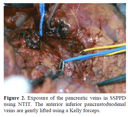 pancreas-exposure-pancreatic-veins-anterior