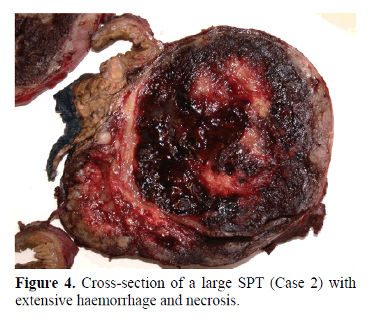 pancreas-extensive-haemorrhage-necrosis