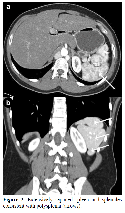 pancreas-extensively-septated-spleen