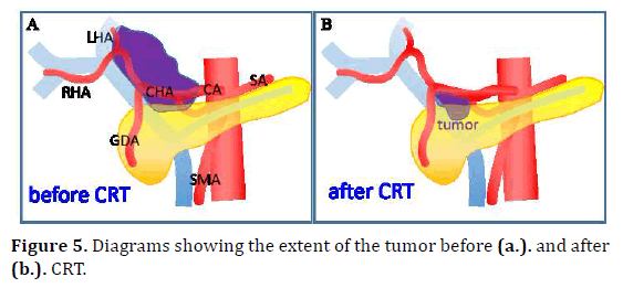 pancreas-extent-tumor