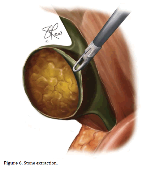 pancreas-extraction