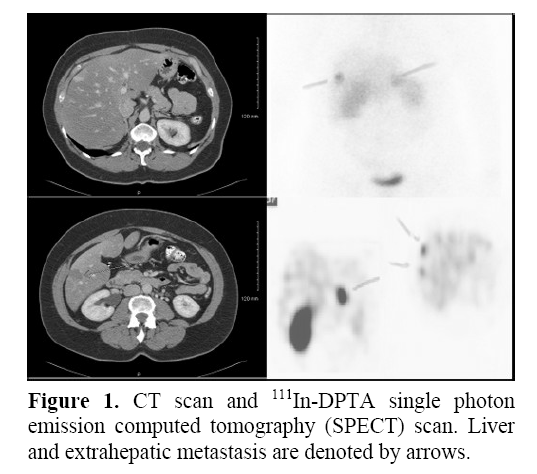 pancreas-extrahepatic-metastasis