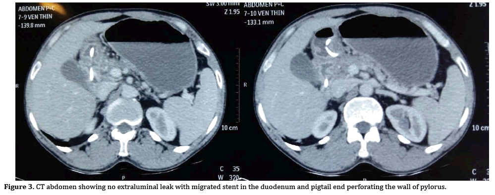 pancreas-extraluminal