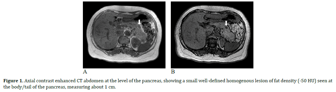 pancreas-fat-density