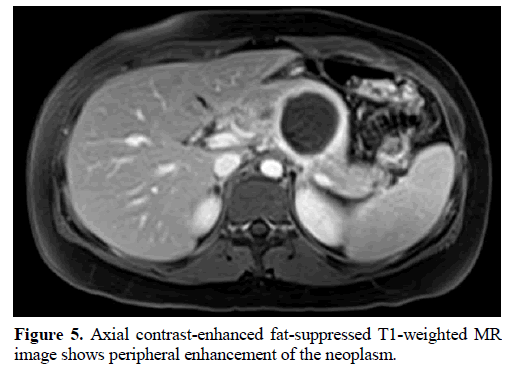 pancreas-fat-suppressed-peripheral