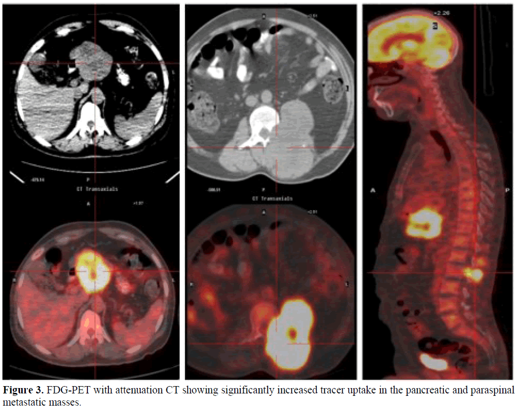 pancreas-fdg-pet-attenuationsignificantly