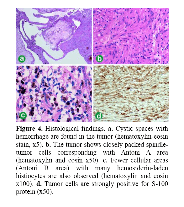 pancreas-fewer-cellular-areas