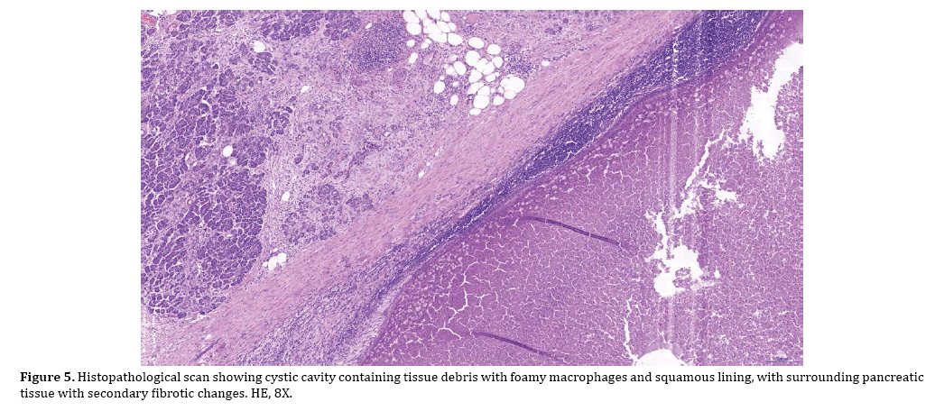 pancreas-fibrotic