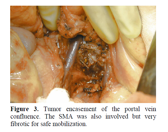 pancreas-fibrotic-safe-mobilization