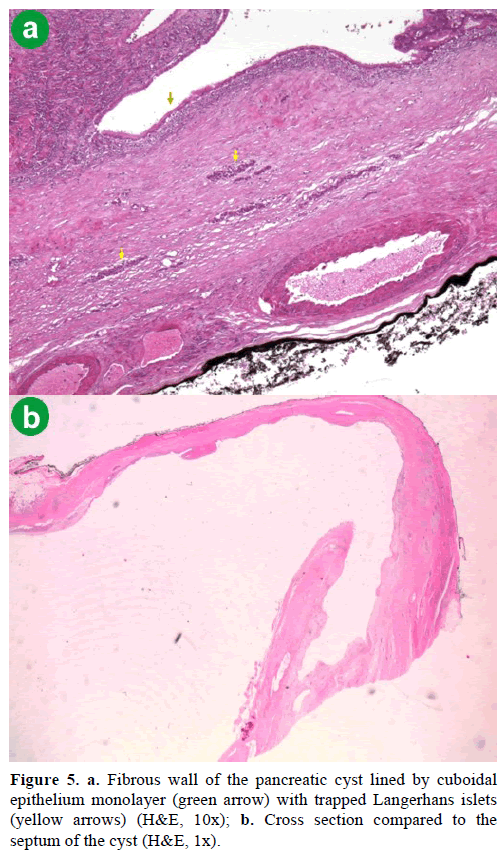 pancreas-fibrous-wall-pancreatic-cyst-lined