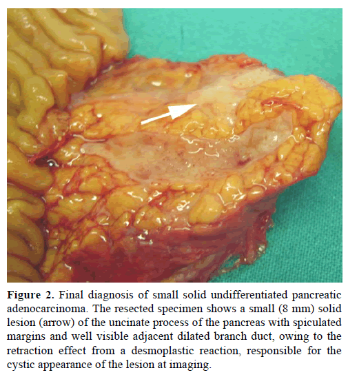 pancreas-final-diagnosis-undifferentiated