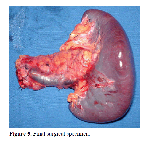 pancreas-final-surgical-specimen