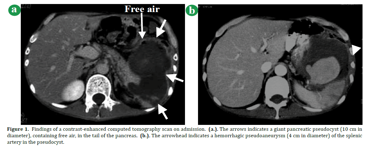 pancreas-findings-contrast-enhanced-computed