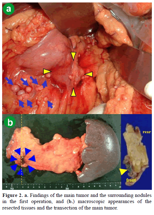pancreas-findings-main-tumor-transection