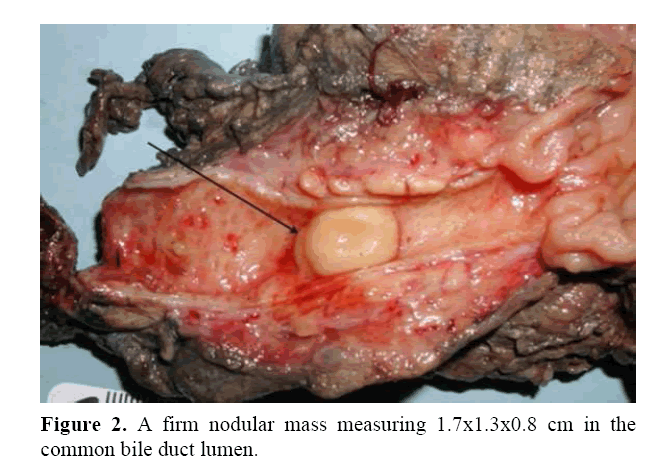 pancreas-firm-nodular-mass-measuring