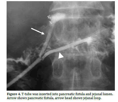 pancreas-fistula